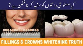Can Fillings & Crowns Be Whitened? – What Are They Made Of? – Teeth Whitening Tips In Urdu