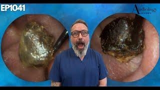 The Most Shocking Ear Wax Removal You've Never Seen - EP1041