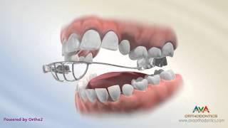 Orthodontic Treatment for Openbite - Upper Tongue Crib Appliance