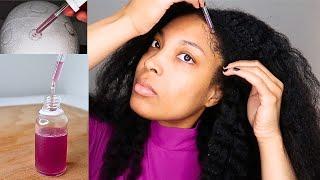 DIY BEST REMEDY FOR ALOPECIA AND MASSIVE HAIR GROWTH | Follow These Steps