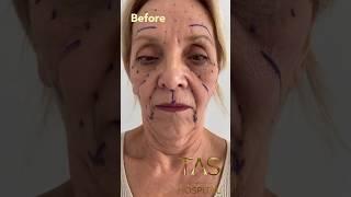 One of the most amazing transformations  from 74 years old to 30 ? #facelift #drsuleymantas