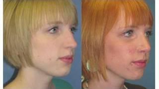 Dr. John Bitner Rhinoplasty (Nose Job)