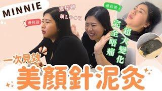 Minnie美顏針泥灸療程實況｜中醫都有急救術！？一次見效 超大變化！｜中醫師大揭秘 點解針灸無痛？泥灸有咩用？｜港人治病必備 #中醫養生 #月經失調 ｜Fit Fit Food 一站式健康營養中心