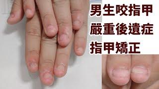 Boy biting nails - very serious finger-exposed, 13-week special nail correction example