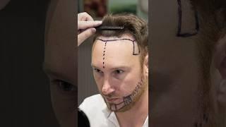 Cosmedica Clinic Hair Transplant in Turkey #shorts #hairtransplant #video