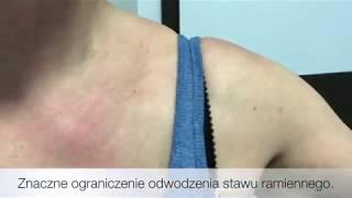 Poprawa u pacjentki z bólem stawu mostkowo-obojczykowego po pierwszym zabiegu u chiropraktyka.