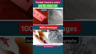 100% blockage Angiography me kaisa dikhta hai l #angiography #echo #shorts