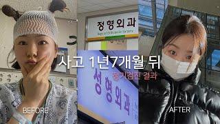 사고..1년 반 지났다! 병원DAY | 분쇄골절&피부이식 정기검진