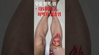 쉬운설명입니다. 러닝하는 사람무릎에서 흔한 통증 1탄 ㅡ 무릎 앞, 안쪽