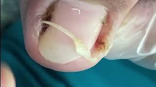 The Big Ingrown Toenail Treatment Tutorial #tonailroomb