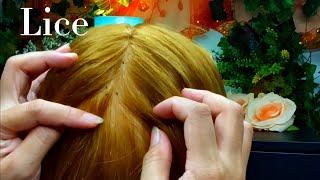 ASMR Lice Removal, Pop the Lice directly on the Scalp and nails 