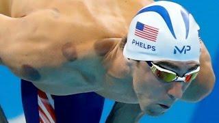 Why Olympians are doing the "cupping" treatment