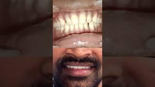 Single Visit SMILE Designing At ELEDENT Dental Hospital | Best Dental Hospital In Hyderabad #shorts