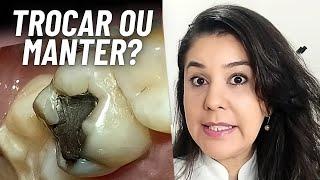 Restauração de dente/ Você sabe por que deve trocar sua restauração de amálgama dental?