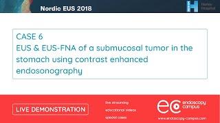 Livedemo | Nordic EUS 2018 | EUS & EUS-FNA of a submucosal tumor in the stomach