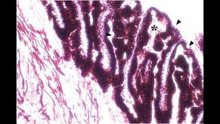 Cyclophotocoagulation Part II: Endocyclophotocoagulation (Malik Y. Kahook, MD)