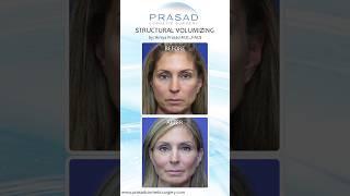 Why Fillers Don't Stretch Facial Skin #filler