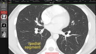 Lobar and Segmental Lung Anatomy on CT