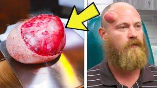 Man Has Huge Head Lump For 20 Years, What He Discovered After Removing It Will Terrify You