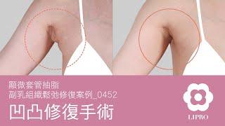 凹凸修復手術｜顯微套管抽脂｜副乳組織鬆弛修復案例_0452