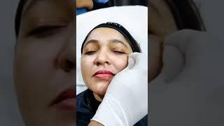 Dr. Shilpi Bhadani trying the BOTOX treatment #botox #botoxtreatment #botoxfiller #shorts #ytshorts