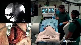 Anterior Cervical Disc Replacement - Hyun Bae, MD