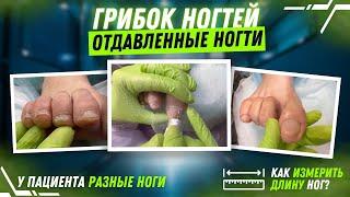 Грибок ногтей. Отдавленные ногти. Как измерить длину ног?У пациента разные ноги #ноги #лето