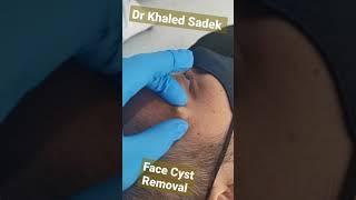 #cystremoval #blackheads #pimples #drkhaledsadek Dr Khaled Sadek Lipomacyst.com