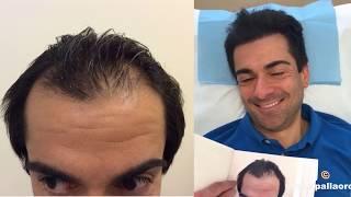 Trapianto capelli con tecnnica Micro FUE HD dopo 5 mesi