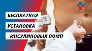 Бесплатная установка инсулиновых помп