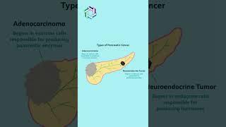 Types of Pancreatic Cancer Explained : Knowing the Different Forms | Dr Vivek Sukumar