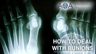 AOA Orthopedic Specialists - Dr. Don Stewart - How to Deal with Bunions