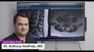 What is Lumbar Spinal Stenosis? | Anthony Giuffrida, MD