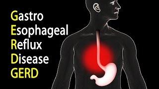 GERD - Gastroesophageal Reflux Disease or Gastric Reflux, Animation.