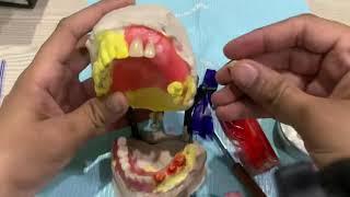 Partial denture setup #umairtoothfairy #dentist #umairazeem #smile @Umairazeem8553