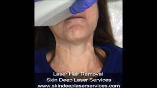 Laser Hair Removal Upper Lip, Painless and Fast,Skin Deep ,Fairfax County VA, Burke VA, Northern VA