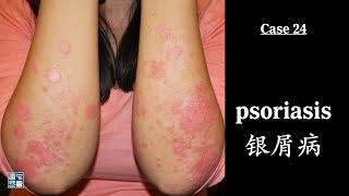 Psoriasis 银屑病 (牛皮癣), why subside psoriasis area turn white? 为什么消退处的牛皮癣是白色？