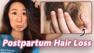 Postpartum Hair Loss | Dermatologist Dr. Joyce Park