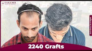 Hair Transplant Results | Best Cost & Best Hair Transplant Result