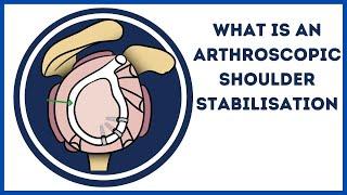 What is an Anterior Shoulder Stabilisation?