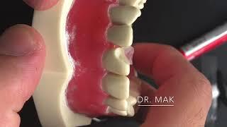 Clinical Demonstration for the CLASS IV Composite Technique.