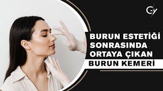 Burun Estetiği Sonrasında Ortaya Çıkan Burun Kemeri