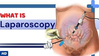 What Is Laparoscopy?