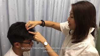 Zhu's Scalp Acupuncture For Sciatica