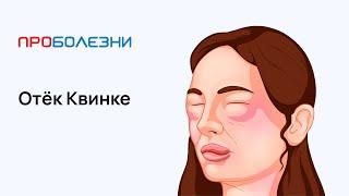 Отёк Квинке