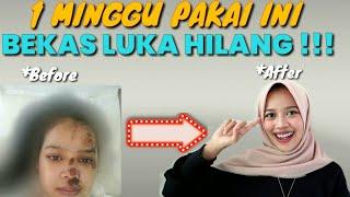 1 minggu pakai ini bekas luka hilang!!!