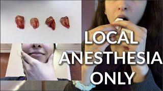 Getting ALL 4 WISDOM TEETH Removed (NO GENERAL ANESTHESIA!!)