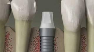 Dental Implants - Replace Missing Teeth - Procedure in Denville, NJ