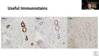 Tip-5; Mesonephric Remnants in the Cervix