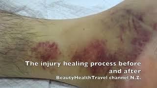 Injury healing home remedy before and after